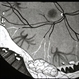 vitreous snowballs, peripheral retinal neovascularization, inferior snowbanking, and vascular sheathing
